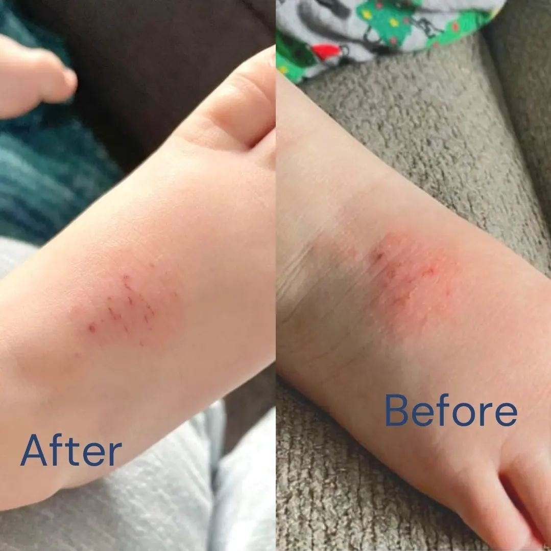 Before and after split image showing reduction in dry, irritated skin on a child's ankle after using BARE. Rooibos Lotion