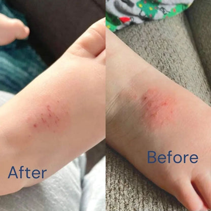 Before and after split image showing reduction in dry, irritated skin on a child's ankle after using BARE. Rooibos Lotion